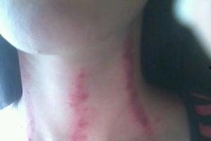 扭痧视频,轻松掌握居家养生新技能