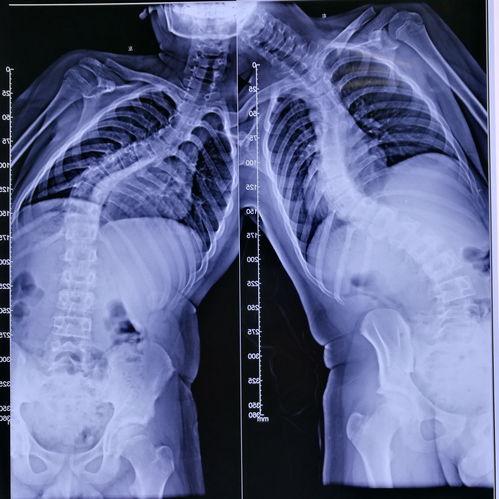 脊柱侧弯手术视频,技术革新与康复之路