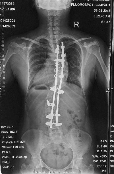 脊柱侧弯手术视频,技术革新与康复之路