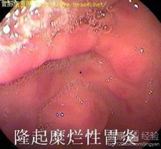 胃炎可以吃黑瓜吗小孩子,黑瓜适宜与否解析